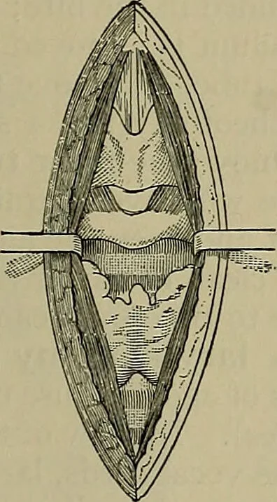 An illustration from Modern surgery, general and operative / by John Chalmers DaCosta., 1914, leaf 907