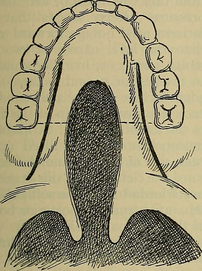 An illustration from Modern surgery, general and operative / by John Chalmers DaCosta., 1914, leaf 945