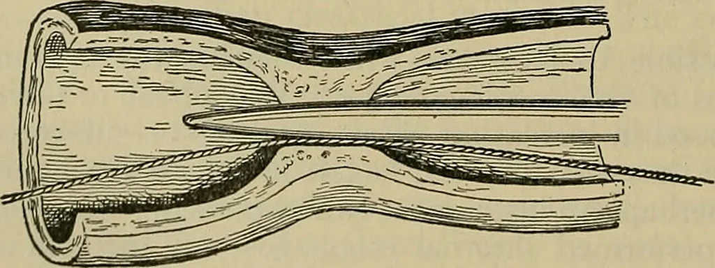 An illustration from Modern surgery, general and operative / by John Chalmers DaCosta., 1914, leaf 960
