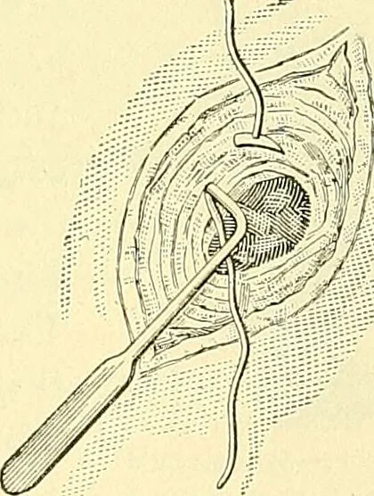 An illustration from Modern surgery, general and operative / by John Chalmers Da Costa., 1907, leaf 1003