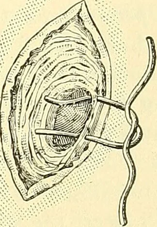 An illustration from Modern surgery, general and operative / by John Chalmers Da Costa., 1907, leaf 1003