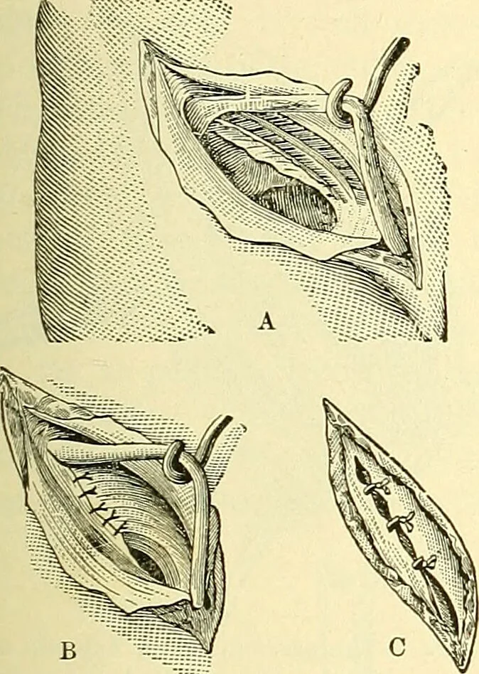 An illustration from Modern surgery, general and operative / by John Chalmers Da Costa., 1907, leaf 1005