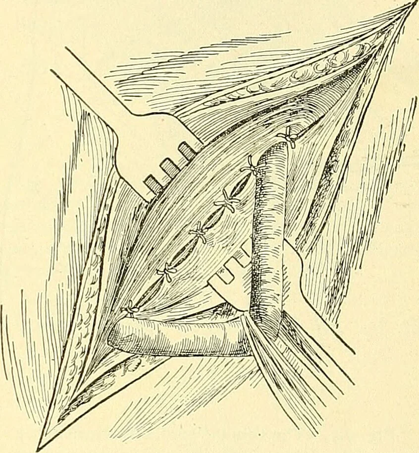 An illustration from Modern surgery, general and operative / by John Chalmers Da Costa., 1907, leaf 1005