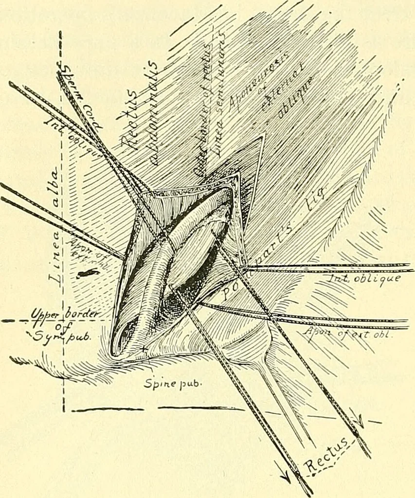 An illustration from Modern surgery, general and operative / by John Chalmers Da Costa., 1907, leaf 1008