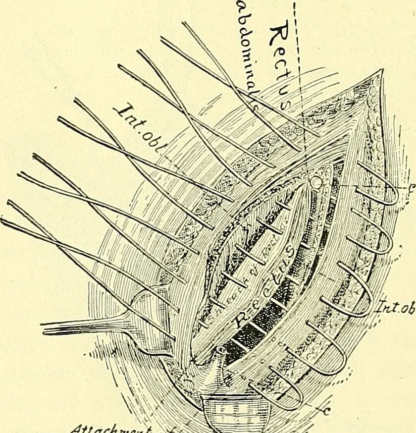 An illustration from Modern surgery, general and operative / by John Chalmers Da Costa., 1907, leaf 1008