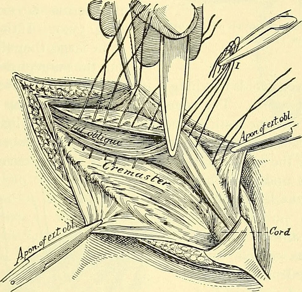 An illustration from Modern surgery, general and operative / by John Chalmers Da Costa., 1907, leaf 1009