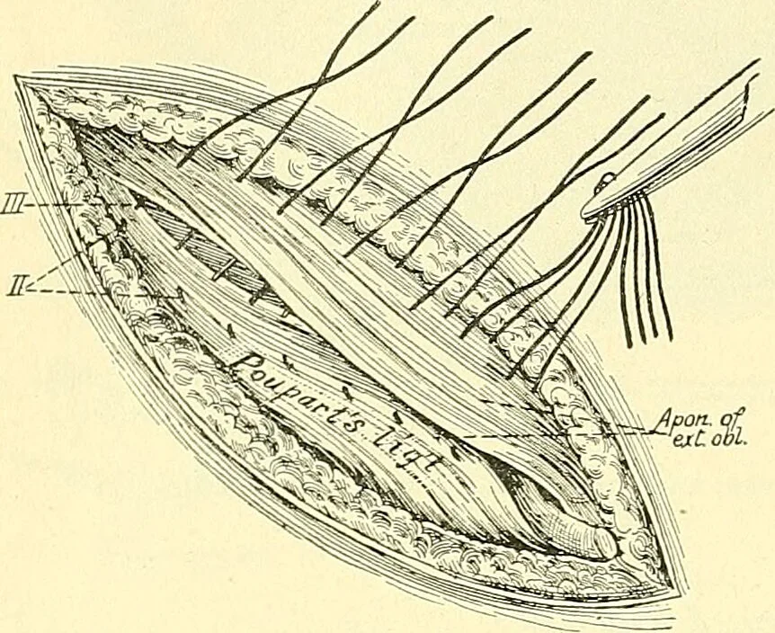 An illustration from Modern surgery, general and operative / by John Chalmers Da Costa., 1907, leaf 1010