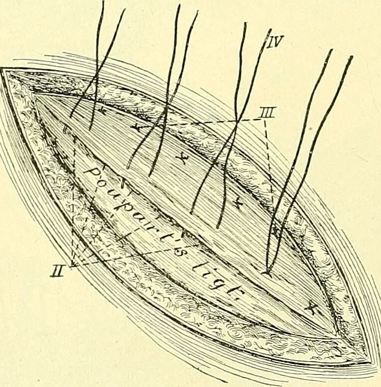 An illustration from Modern surgery, general and operative / by John Chalmers Da Costa., 1907, leaf 1010