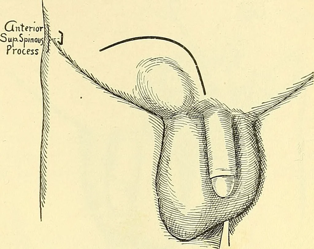 An illustration from Modern surgery, general and operative / by John Chalmers Da Costa., 1907, leaf 1011