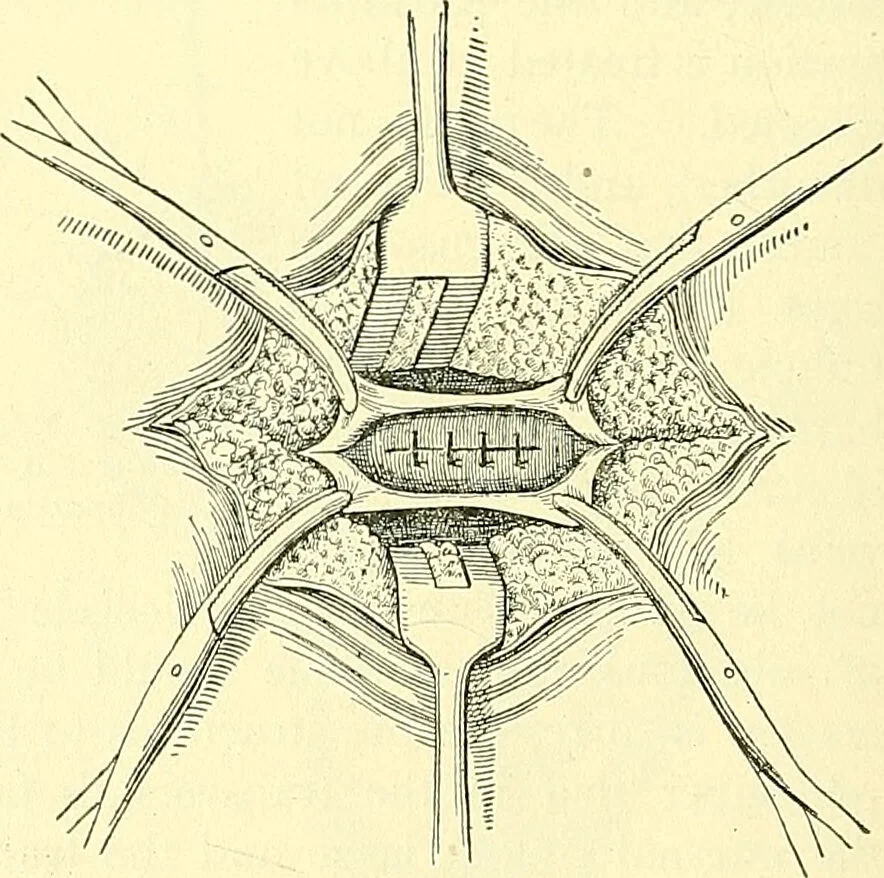 An illustration from Modern surgery, general and operative / by John Chalmers Da Costa., 1907, leaf 1014
