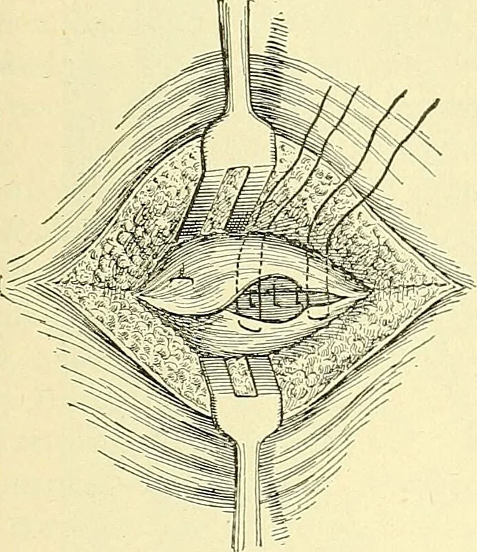 An illustration from Modern surgery, general and operative / by John Chalmers Da Costa., 1907, leaf 1015