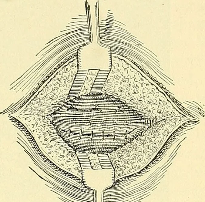 An illustration from Modern surgery, general and operative / by John Chalmers Da Costa., 1907, leaf 1015