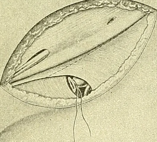 An illustration from Modern surgery, general and operative / by John Chalmers Da Costa., 1907, leaf 1015