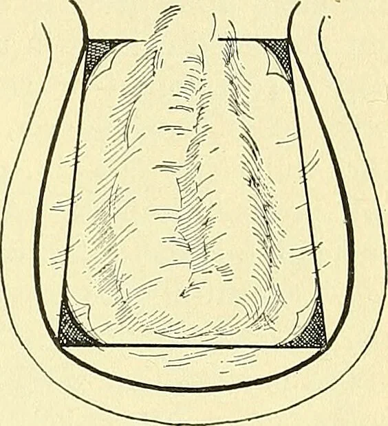 An illustration from Modern surgery, general and operative / by John Chalmers Da Costa., 1907, leaf 1017