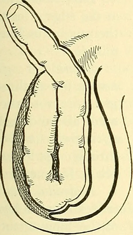 An illustration from Modern surgery, general and operative / by John Chalmers Da Costa., 1907, leaf 1027