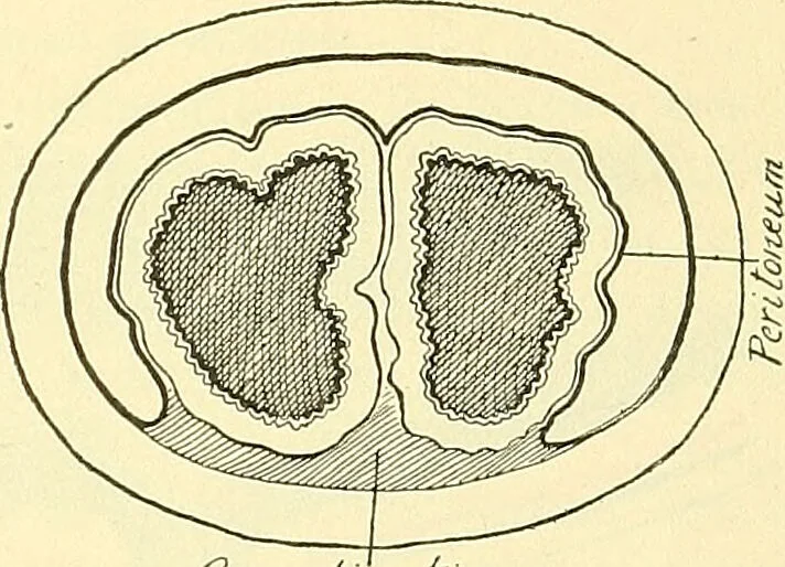 An illustration from Modern surgery, general and operative / by John Chalmers Da Costa., 1907, leaf 1027