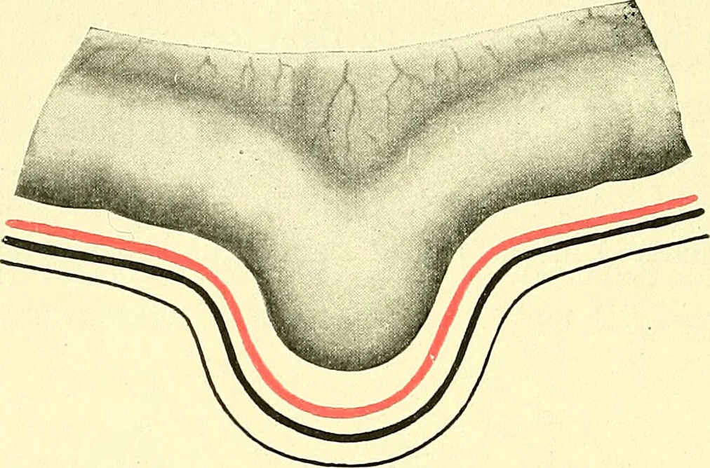 An illustration from Modern surgery, general and operative / by John Chalmers Da Costa., 1907, leaf 1028