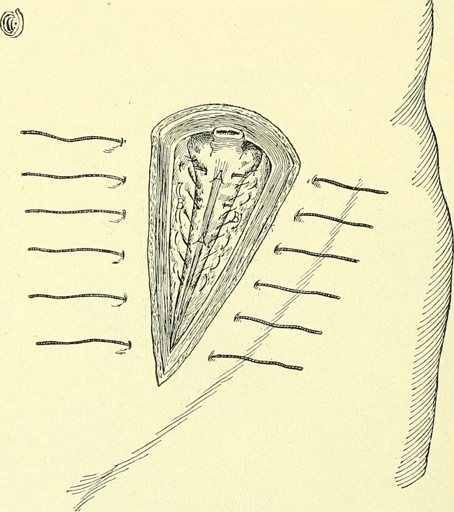 An illustration from Modern surgery, general and operative / by John Chalmers Da Costa., 1907, leaf 1044