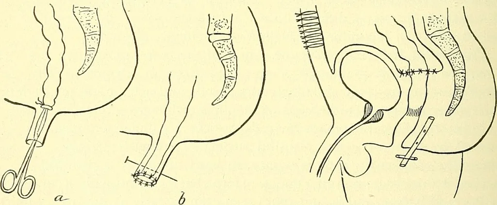 An illustration from Modern surgery, general and operative / by John Chalmers Da Costa., 1907, leaf 1048