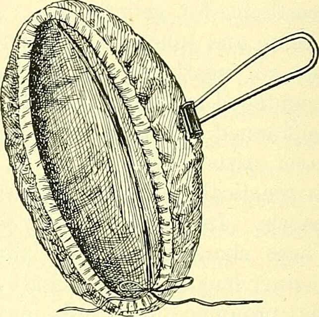 An illustration from Modern surgery, general and operative / by John Chalmers Da Costa., 1907, leaf 1056