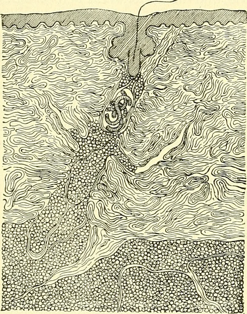 An illustration from Modern surgery, general and operative / by John Chalmers Da Costa., 1907, leaf 1084