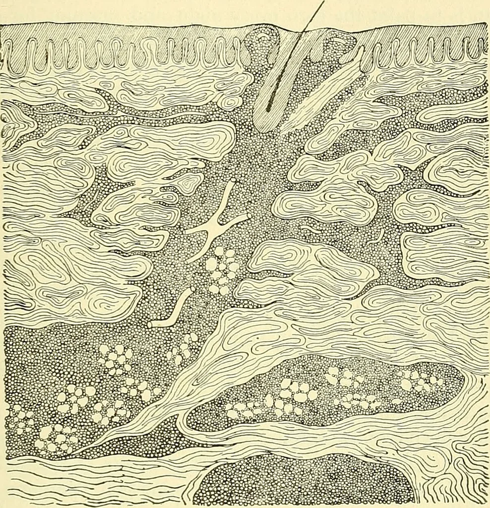 An illustration from Modern surgery, general and operative / by John Chalmers Da Costa., 1907, leaf 1085