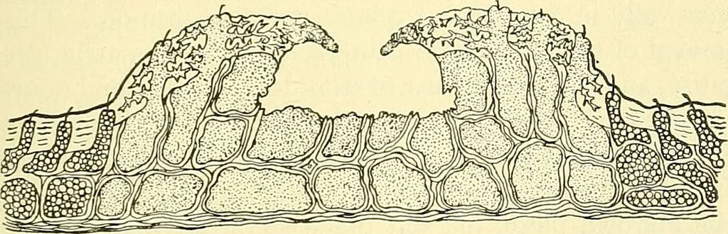 An illustration from Modern surgery, general and operative / by John Chalmers Da Costa., 1907, leaf 1085