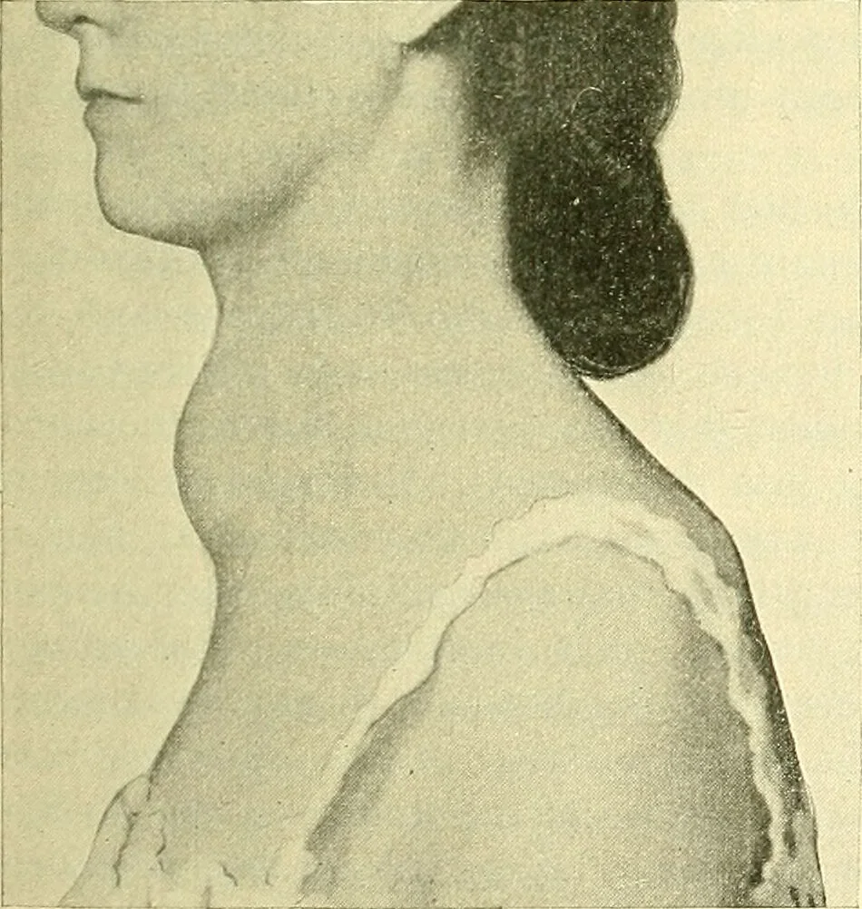 An illustration from Modern surgery, general and operative / by John Chalmers Da Costa., 1907, leaf 1089