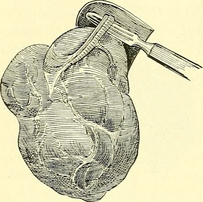 An illustration from Modern surgery, general and operative / by John Chalmers Da Costa., 1907, leaf 1098