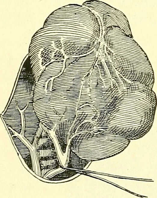 An illustration from Modern surgery, general and operative / by John Chalmers Da Costa., 1907, leaf 1098