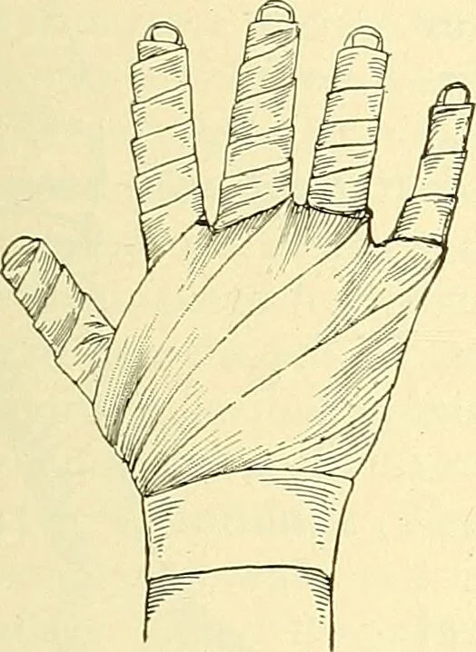 An illustration from Modern surgery, general and operative / by John Chalmers Da Costa., 1907, leaf 1107