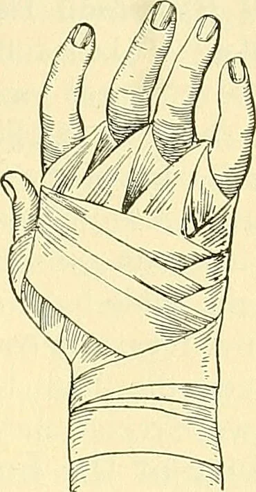 An illustration from Modern surgery, general and operative / by John Chalmers Da Costa., 1907, leaf 1107