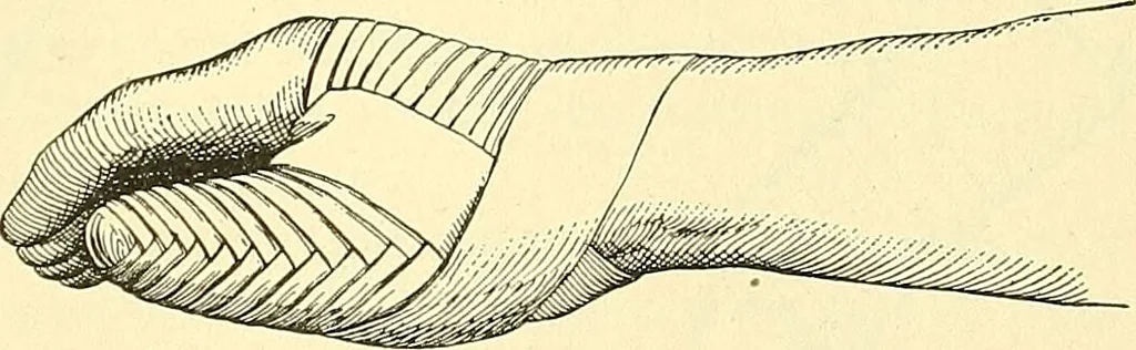 An illustration from Modern surgery, general and operative / by John Chalmers Da Costa., 1907, leaf 1107