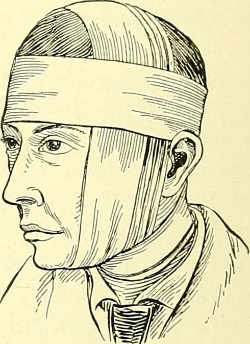 An illustration from Modern surgery, general and operative / by John Chalmers Da Costa., 1907, leaf 1110