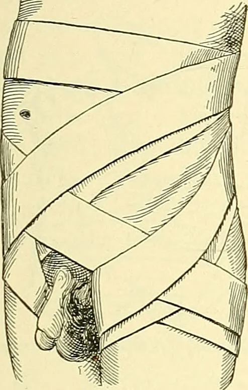 An illustration from Modern surgery, general and operative / by John Chalmers Da Costa., 1907, leaf 1111