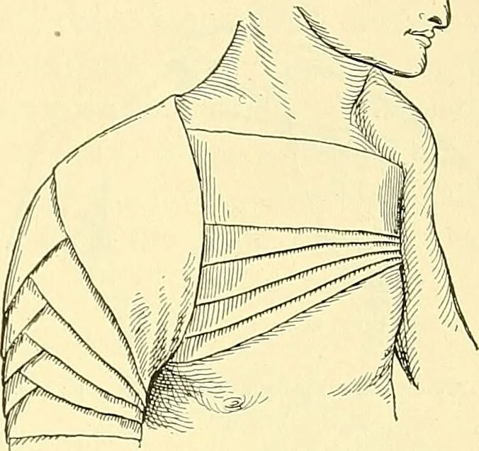 An illustration from Modern surgery, general and operative / by John Chalmers Da Costa., 1907, leaf 1111