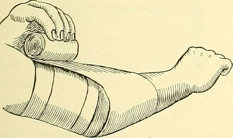 An illustration from Modern surgery, general and operative / by John Chalmers Da Costa., 1907, leaf 1111
