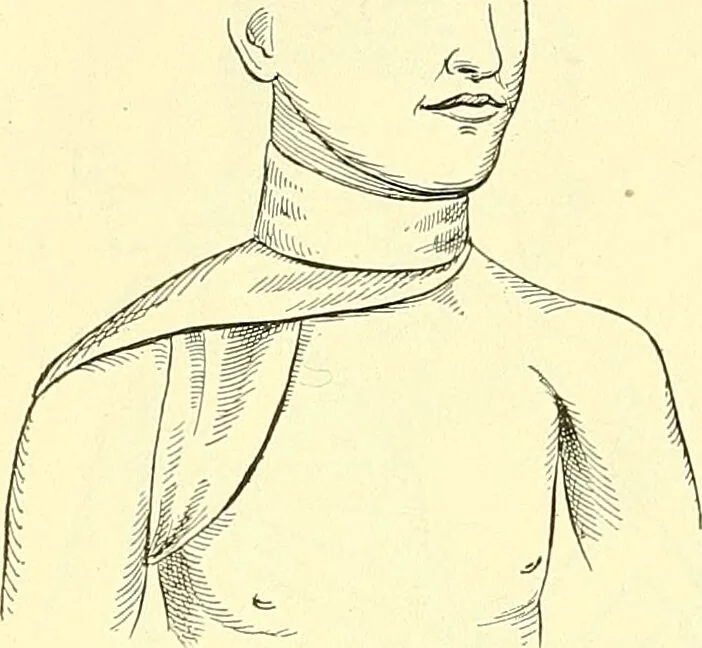 An illustration from Modern surgery, general and operative / by John Chalmers Da Costa., 1907, leaf 1112