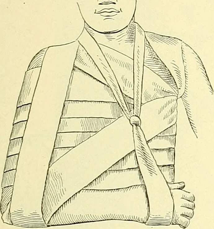 An illustration from Modern surgery, general and operative / by John Chalmers Da Costa., 1907, leaf 1113