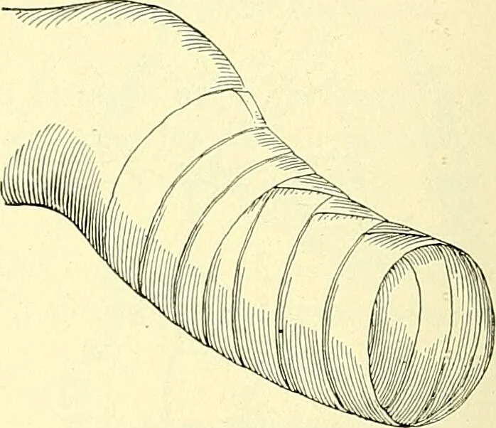 An illustration from Modern surgery, general and operative / by John Chalmers Da Costa., 1907, leaf 1114