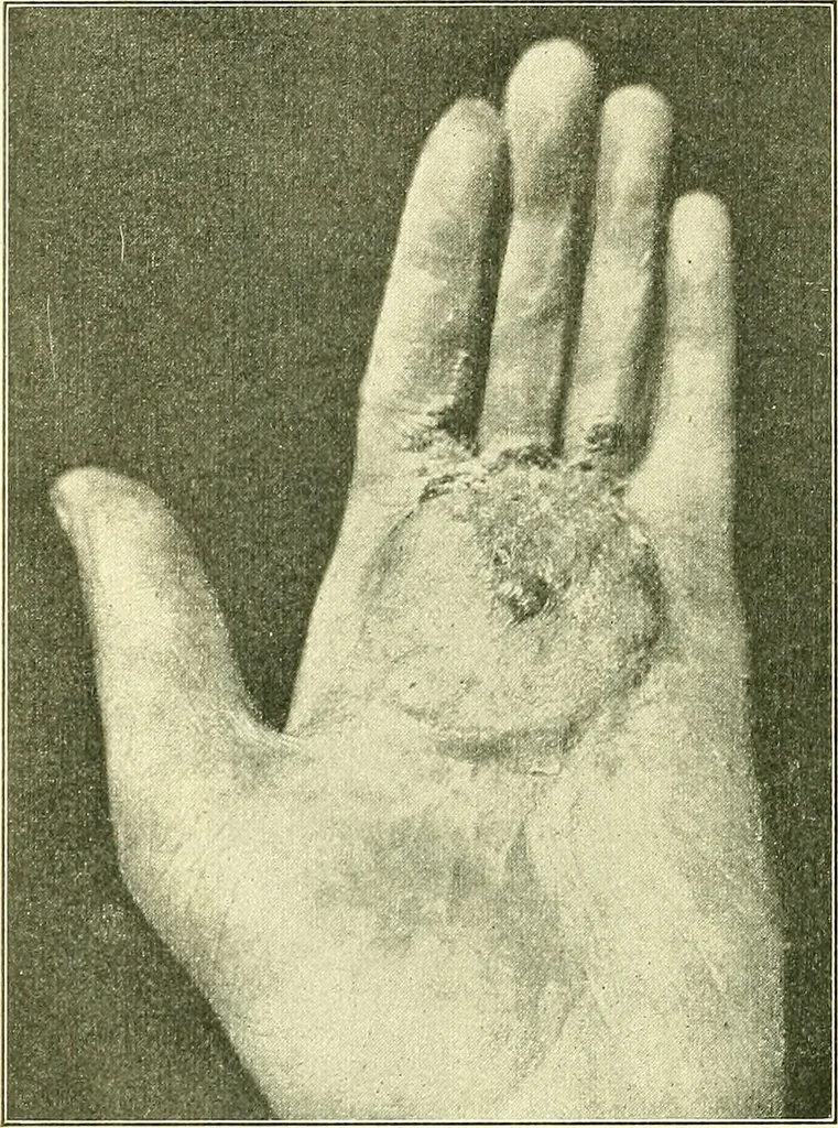 An illustration from Modern surgery, general and operative / by John Chalmers Da Costa., 1907, leaf 1116