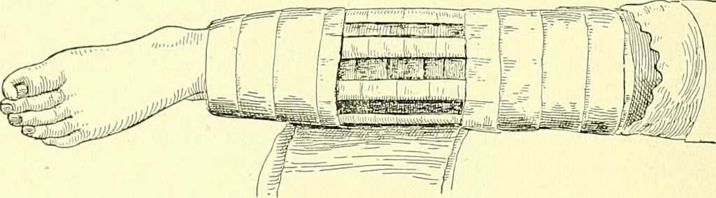 An illustration from Modern surgery, general and operative / by John Chalmers Da Costa., 1907, leaf 1118
