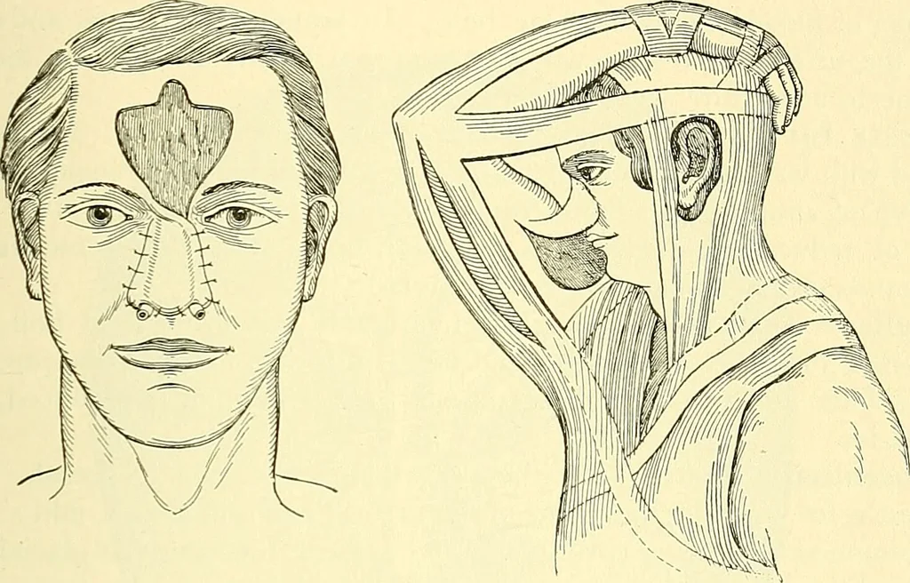 An illustration from Modern surgery, general and operative / by John Chalmers Da Costa., 1907, leaf 1119