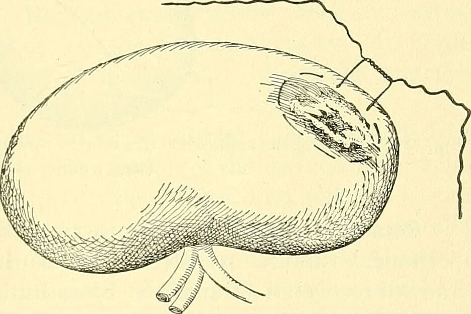 An illustration from Modern surgery, general and operative / by John Chalmers Da Costa., 1907, leaf 1133