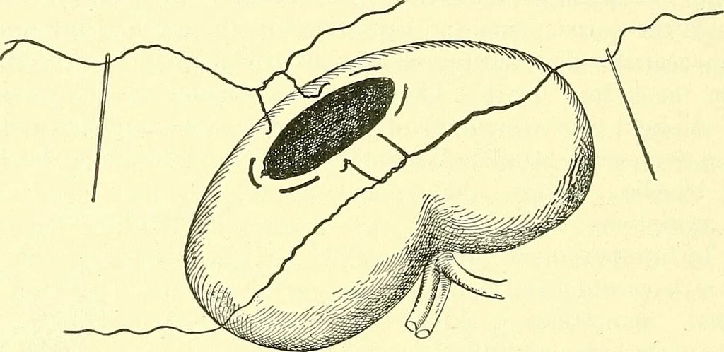 An illustration from Modern surgery, general and operative / by John Chalmers Da Costa., 1907, leaf 1134