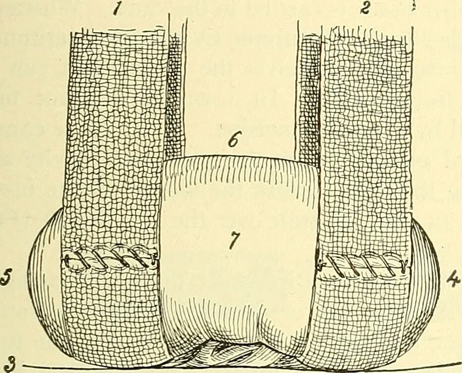 An illustration from Modern surgery, general and operative / by John Chalmers Da Costa., 1907, leaf 1147