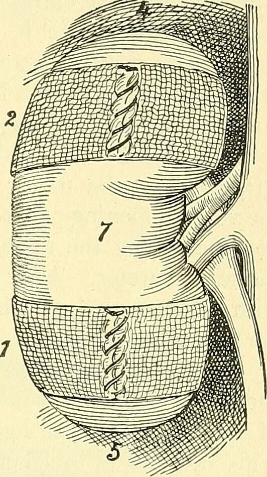 An illustration from Modern surgery, general and operative / by John Chalmers Da Costa., 1907, leaf 1147
