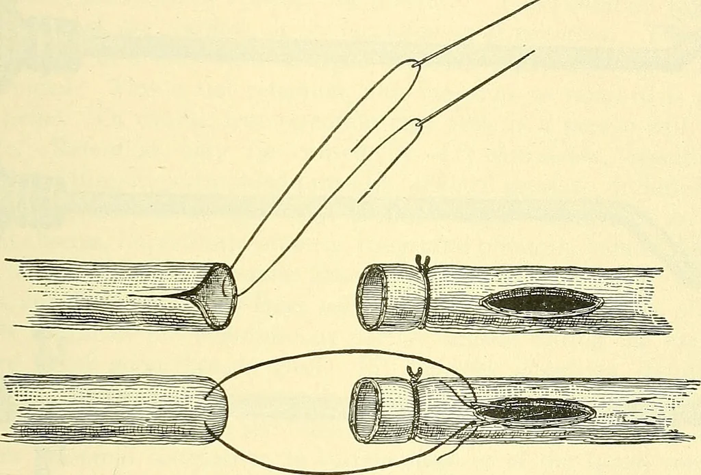 An illustration from Modern surgery, general and operative / by John Chalmers Da Costa., 1907, leaf 1149