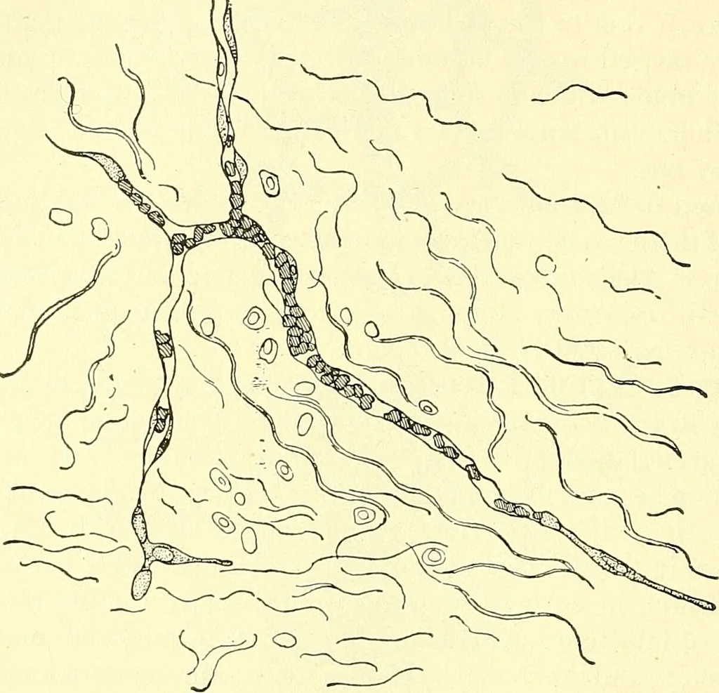 An illustration from Modern surgery, general and operative / by John Chalmers Da Costa., 1907, leaf 120