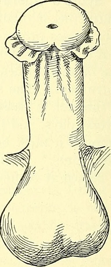 An illustration from Modern surgery, general and operative / by John Chalmers Da Costa., 1907, leaf 1204